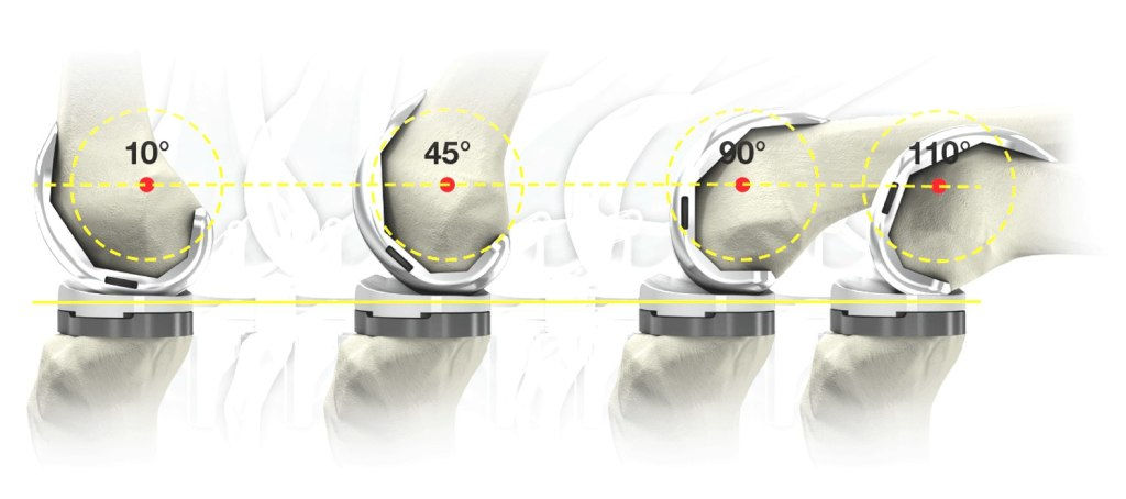 коленный протез 