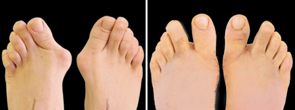 лечение вальгусной деформации стопы