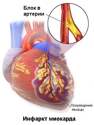 диета после инфаркта