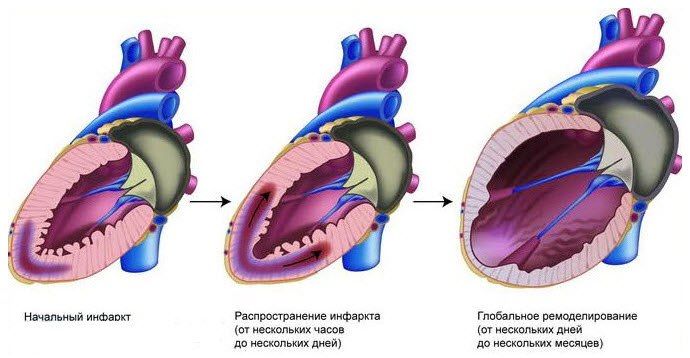 восстановление после инфаркта миокарда