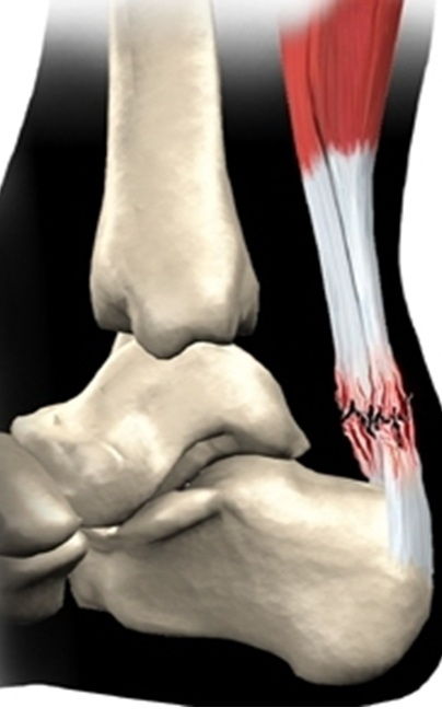 разрыва ахиллова сухожилия